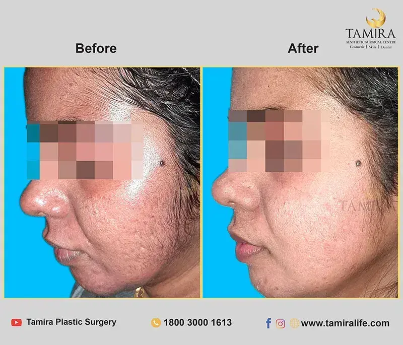 Radiotherapy - Before & After