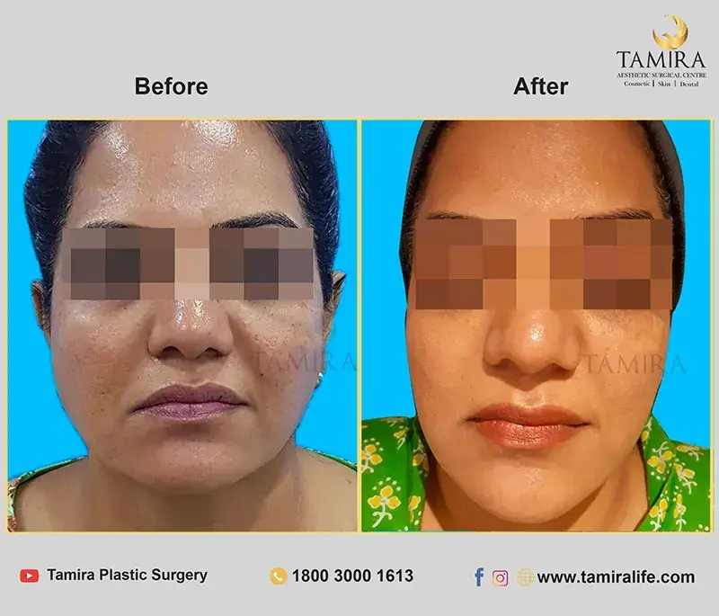 Radiotherapy - Before & After