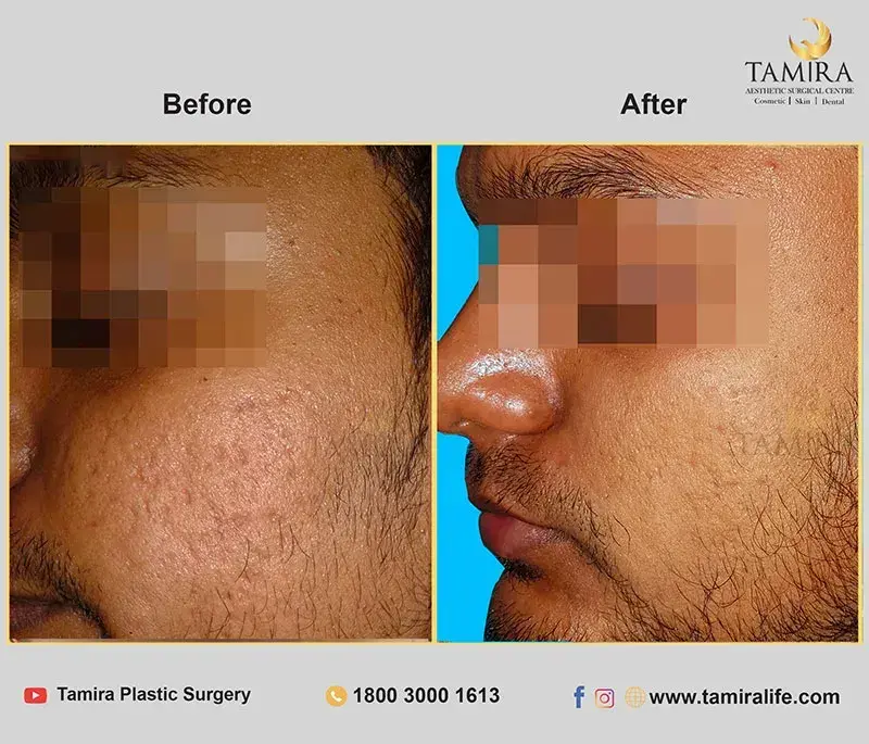 Radiotherapy - Before & After