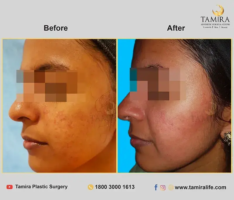 Radiotherapy - Before & After