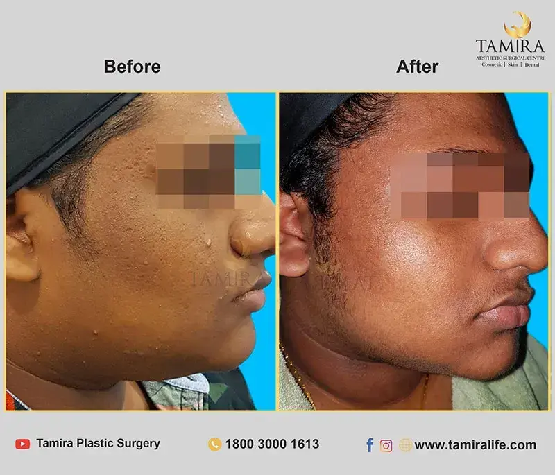 Radiotherapy - Before & After