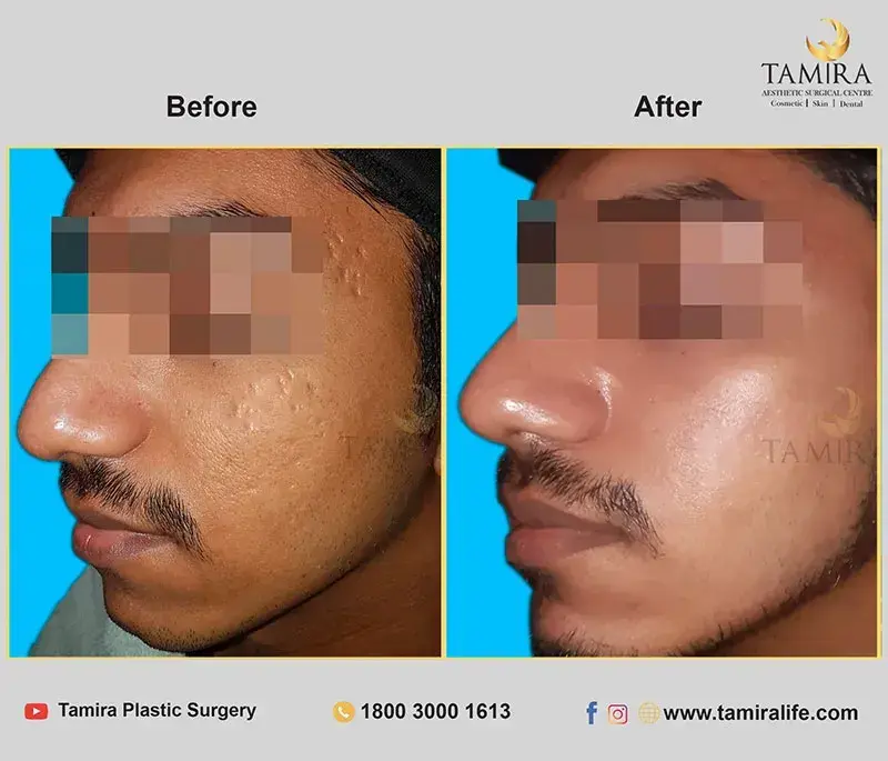Radiotherapy - Before & After