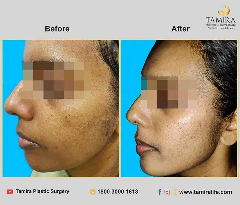 Radiotherapy - Before & After