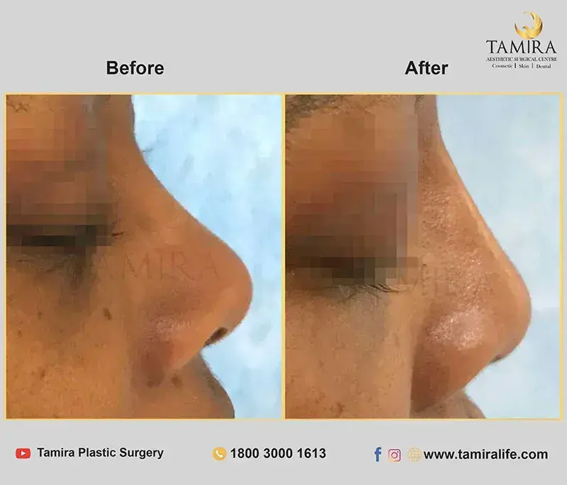 nueromodulator injections (botox) - Before & After