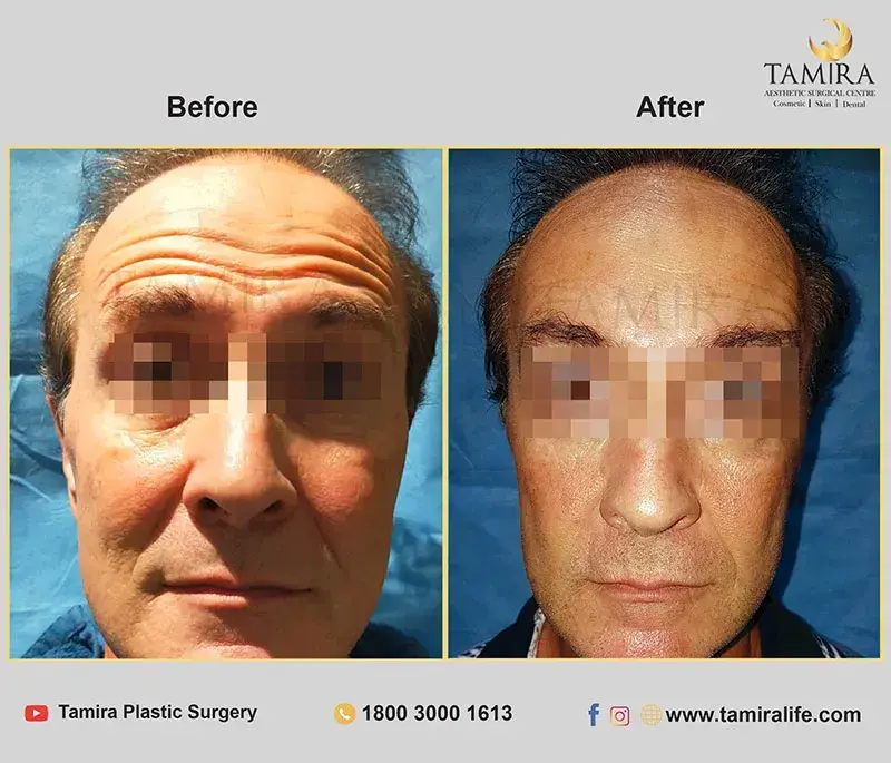 nueromodulator injections (botox) - Before & After