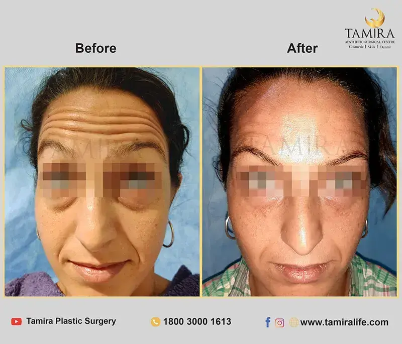 nueromodulator injections (botox) - Before & After
