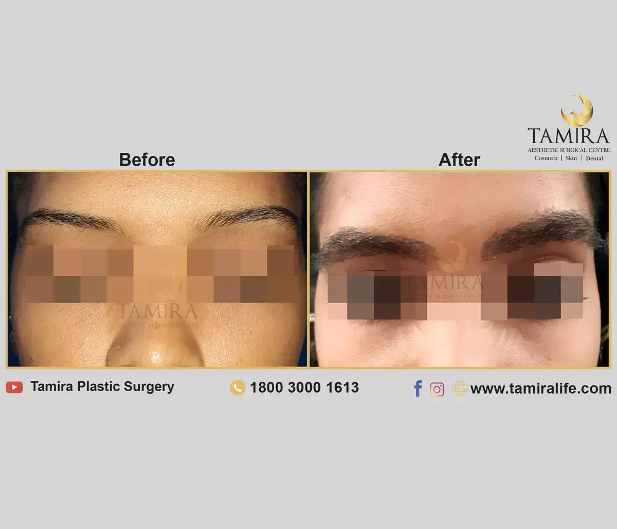 Eyebrow Hair Transplant - Eye Brows - Before & After