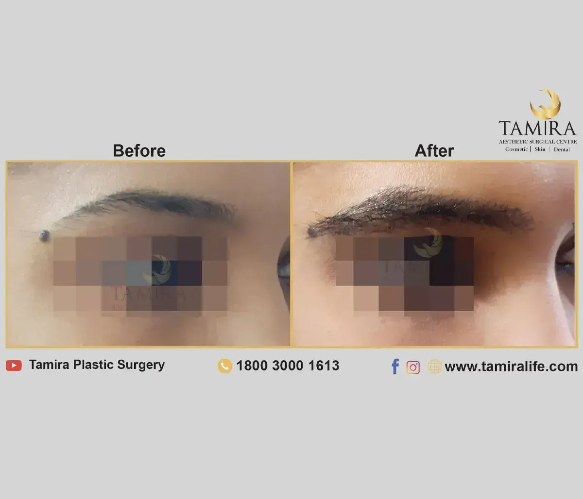 Eyebrow Hair Transplant - Eye Brows - Before & After