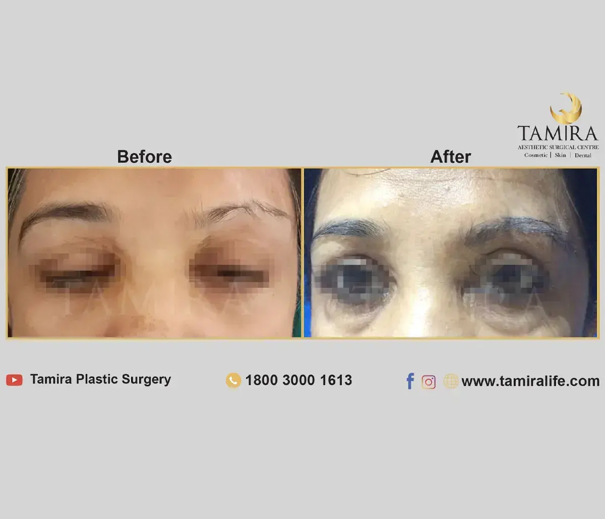 Eyebrow Hair Transplant - Eye Brows - Before & After