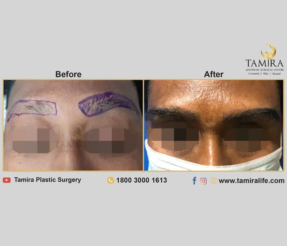 Eyebrow Hair Transplant - Eye Brows - Before & After