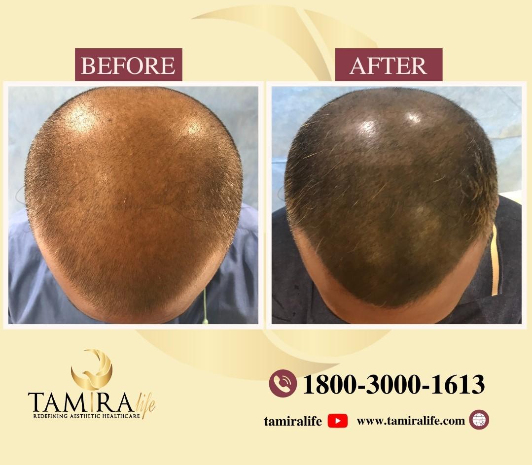 Scalp Micropigmentation