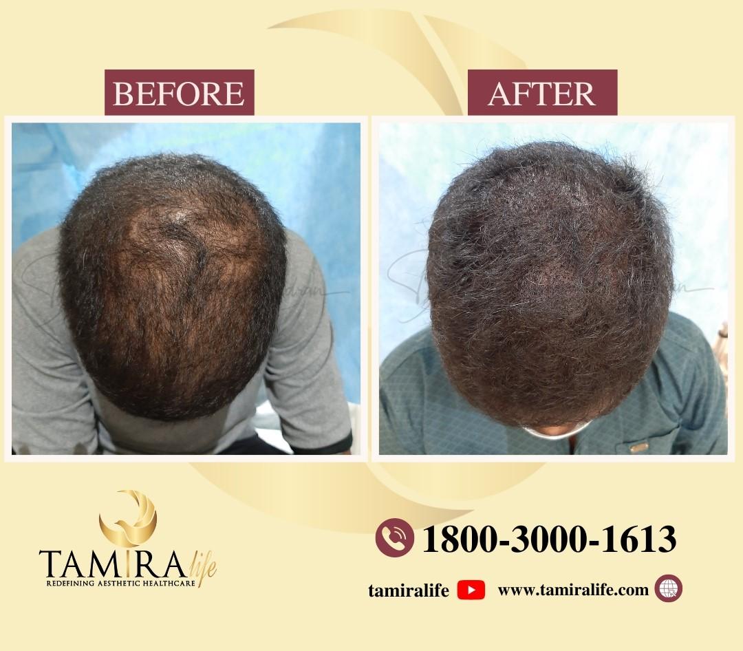 Scalp Micropigmentation