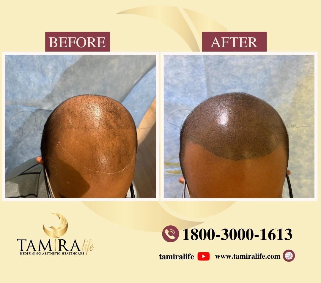 Scalp Micropigmentation
