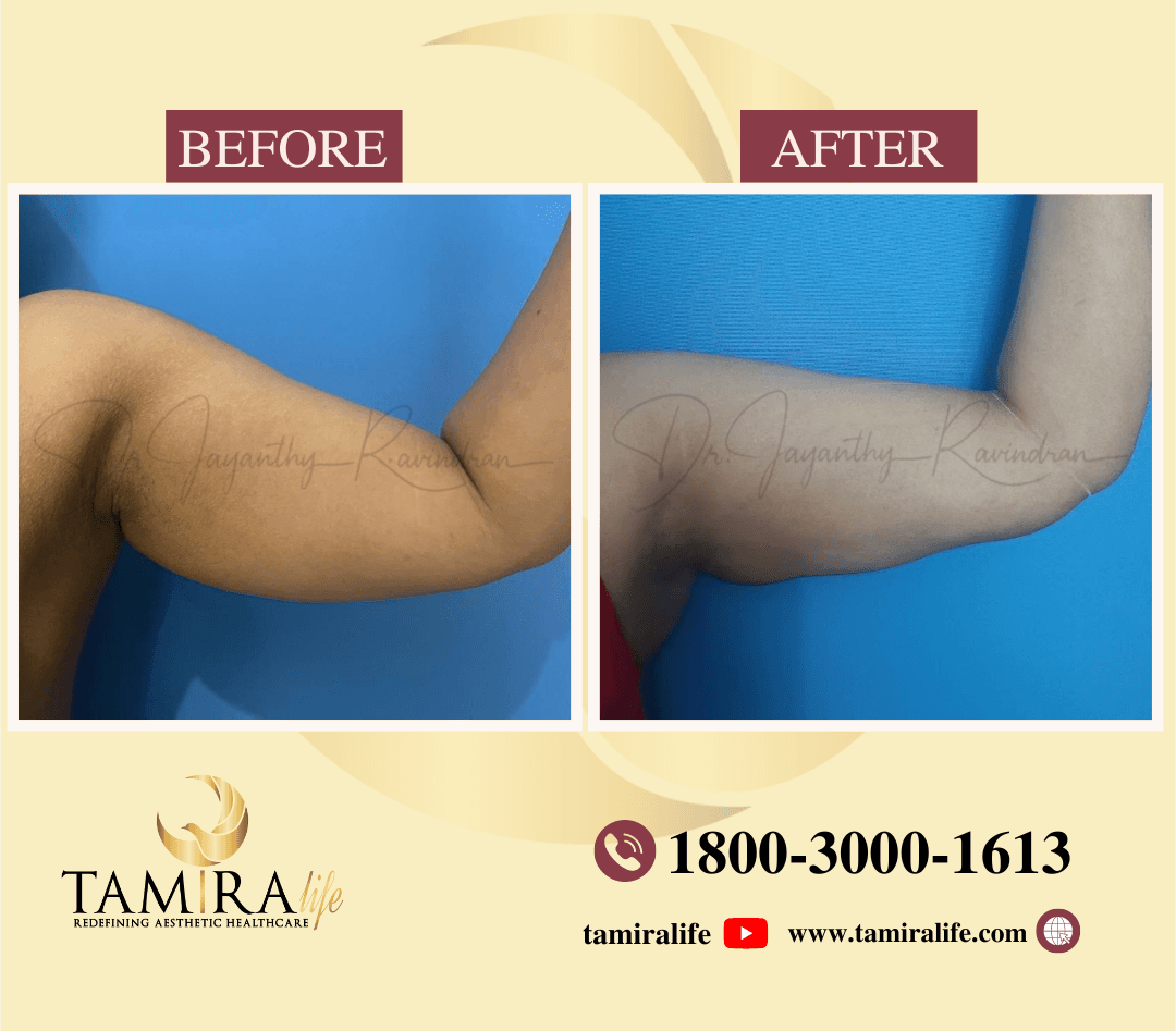 Arm Liposuction