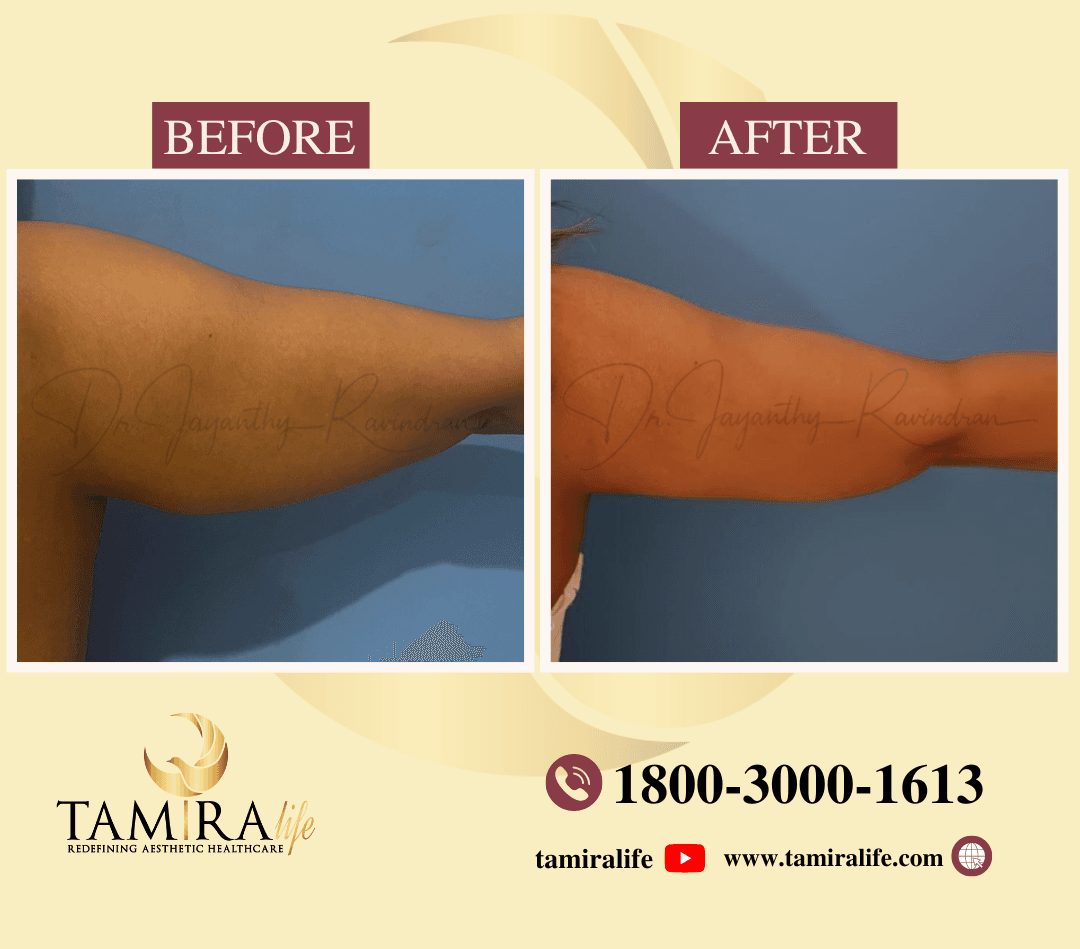 Arm Liposuction