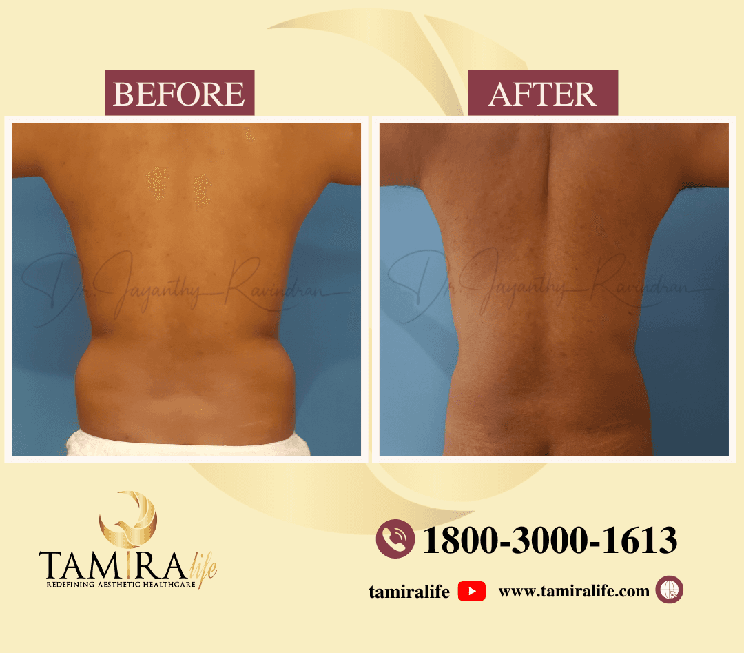 LIPOSUCTION FLANKS