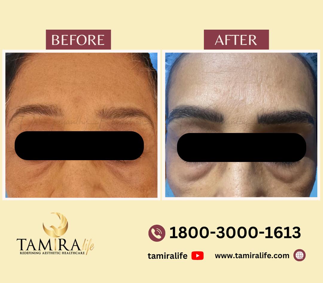 Microblading Eye Brows