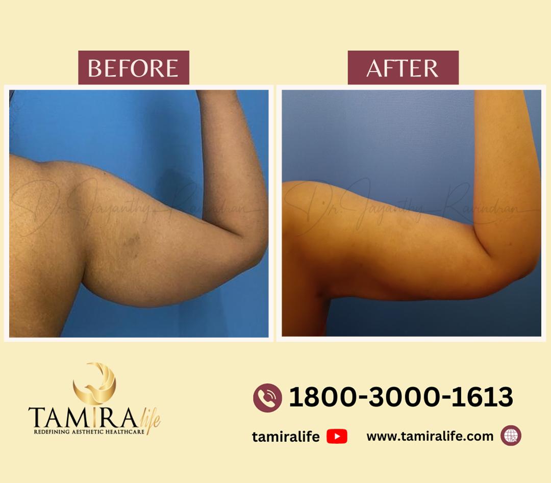 arm liposuction