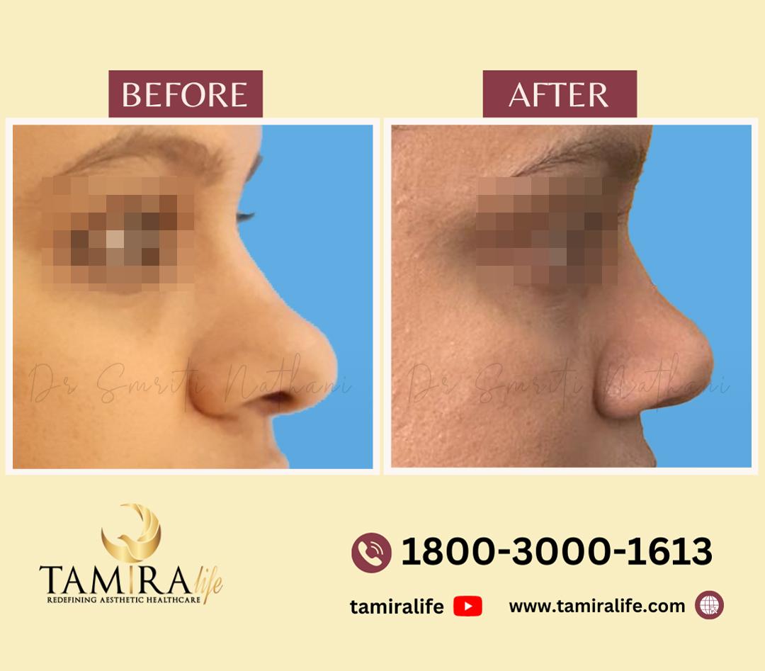 Rhinoplasty