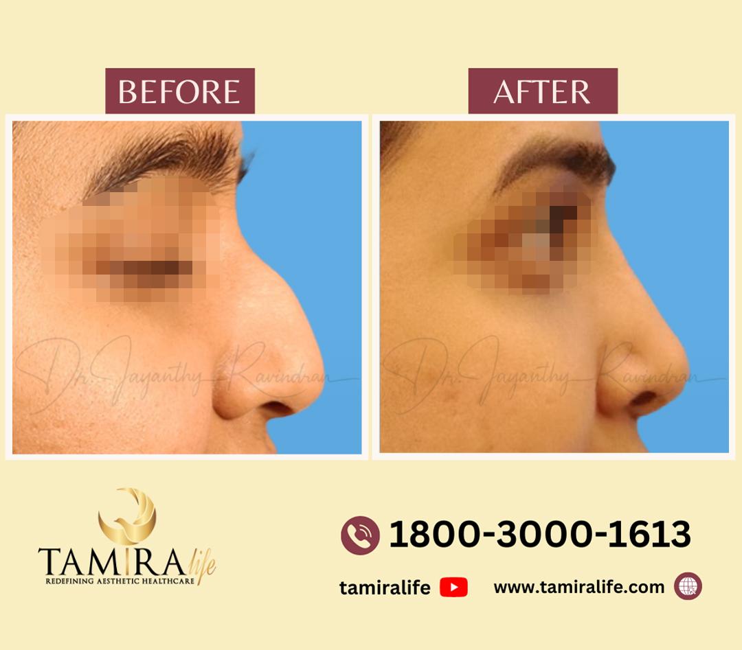 Rhinoplasty