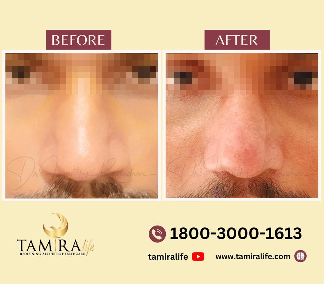 Rhinoplasty