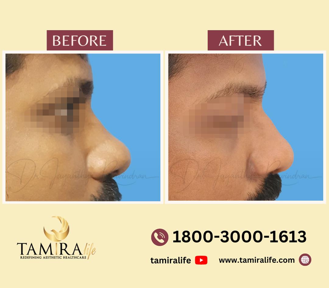 Rhinoplasty