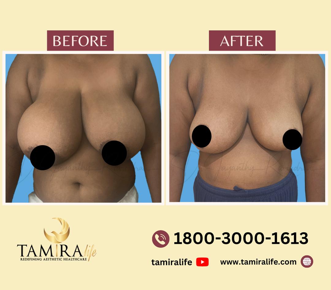 Breast Reduction