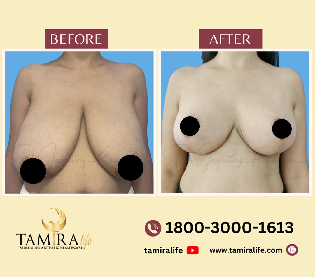 Breast Reduction