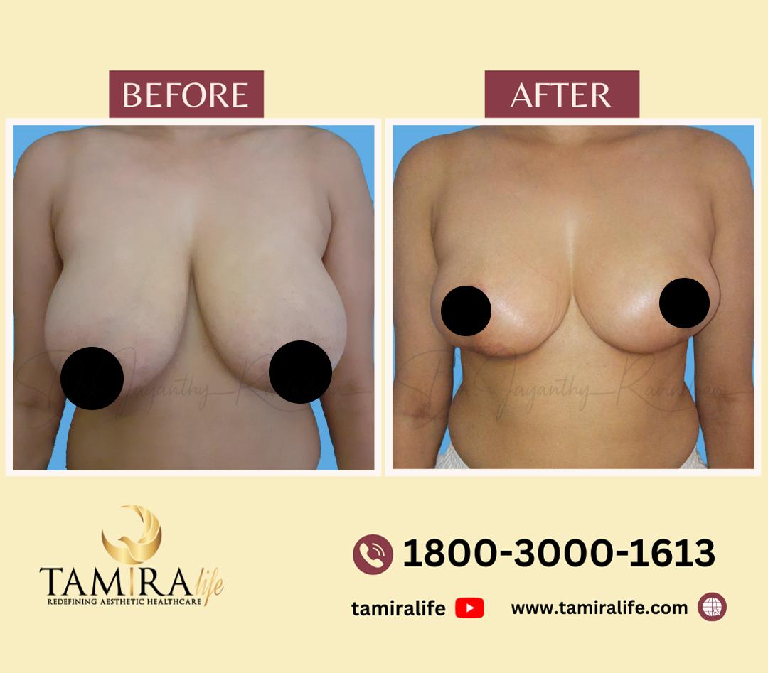 Breast Reduction
