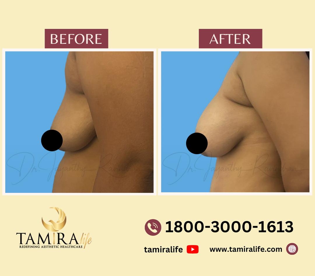 Breast Implant