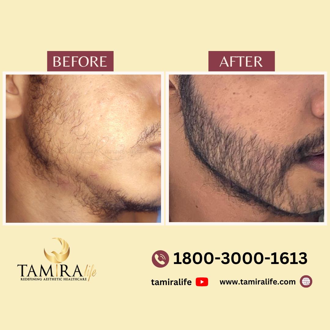 Beard Transplant