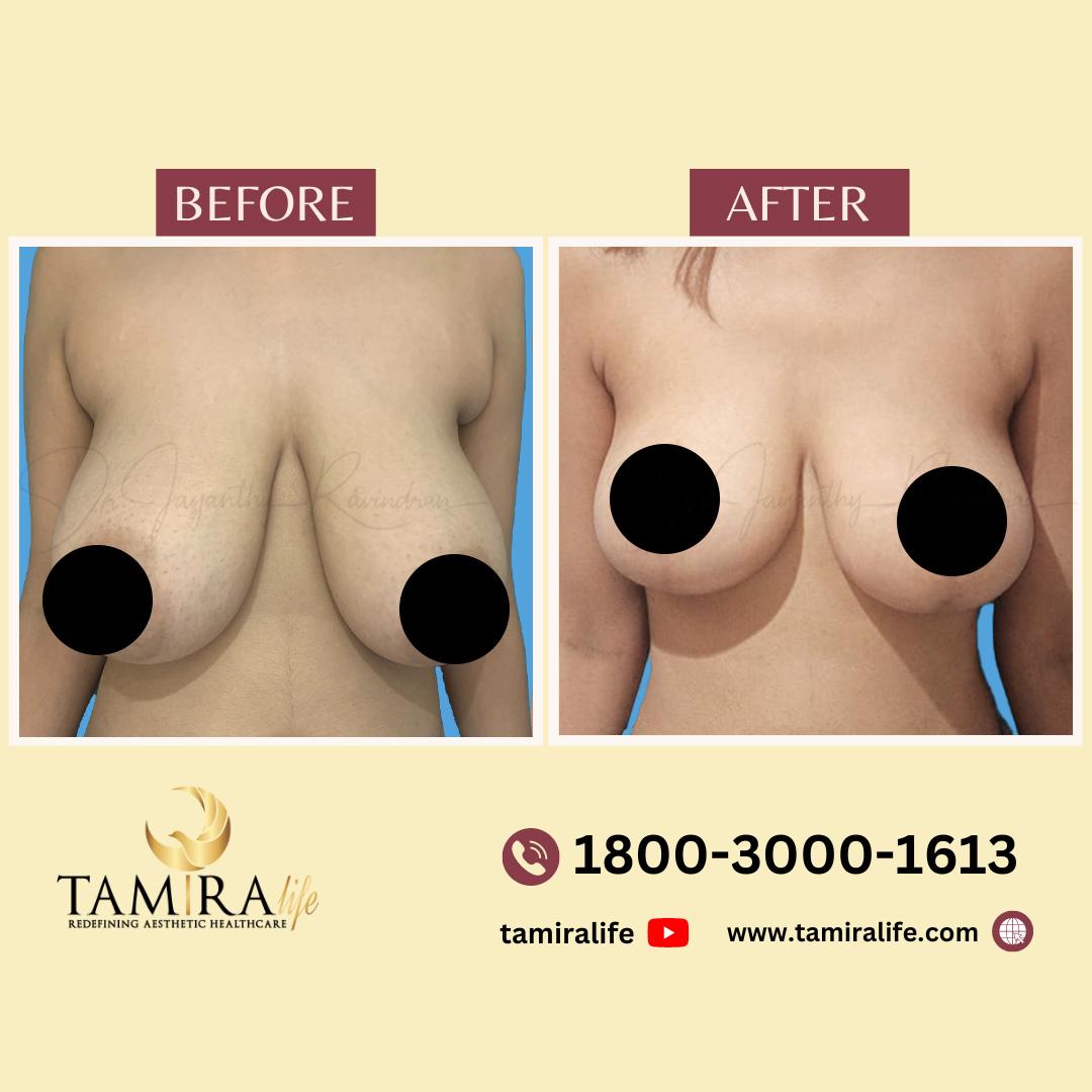 Breast Reduction