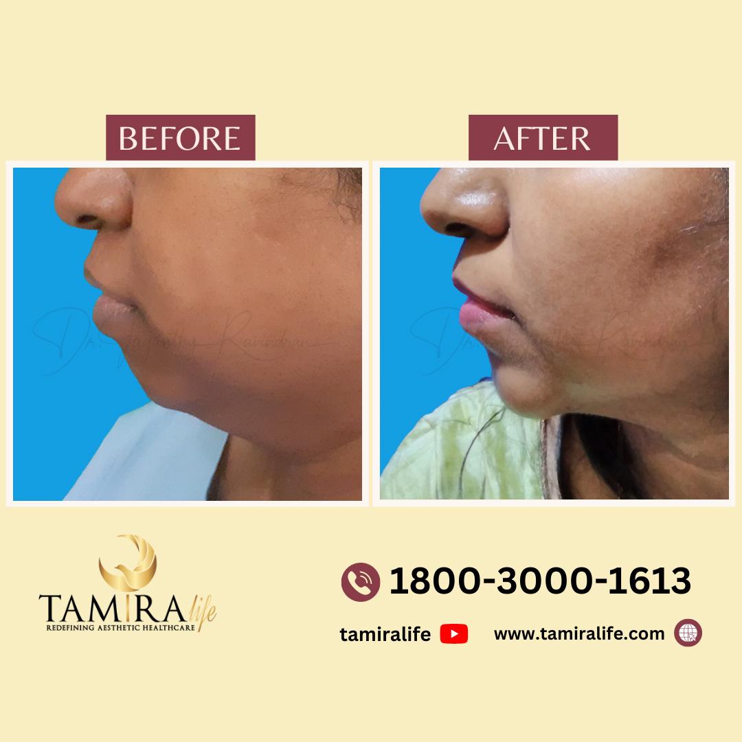 Chin Implant