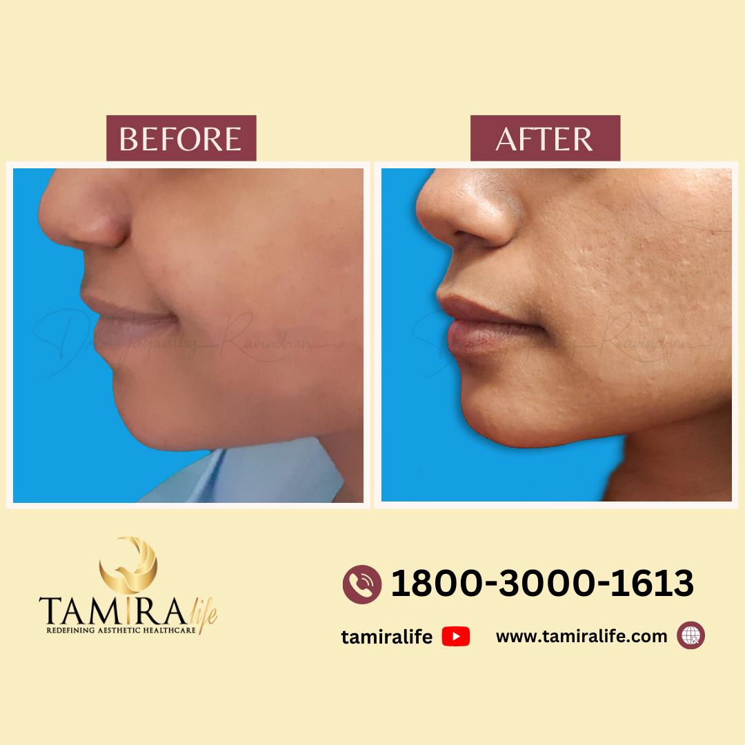 Chin Implant