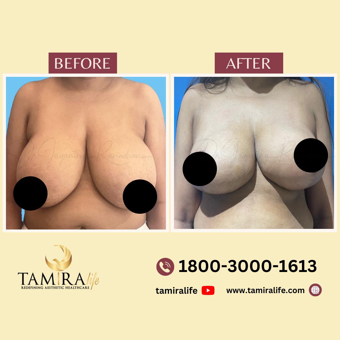 Breast Reduction