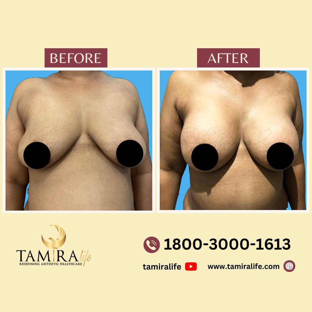 Breast Implant