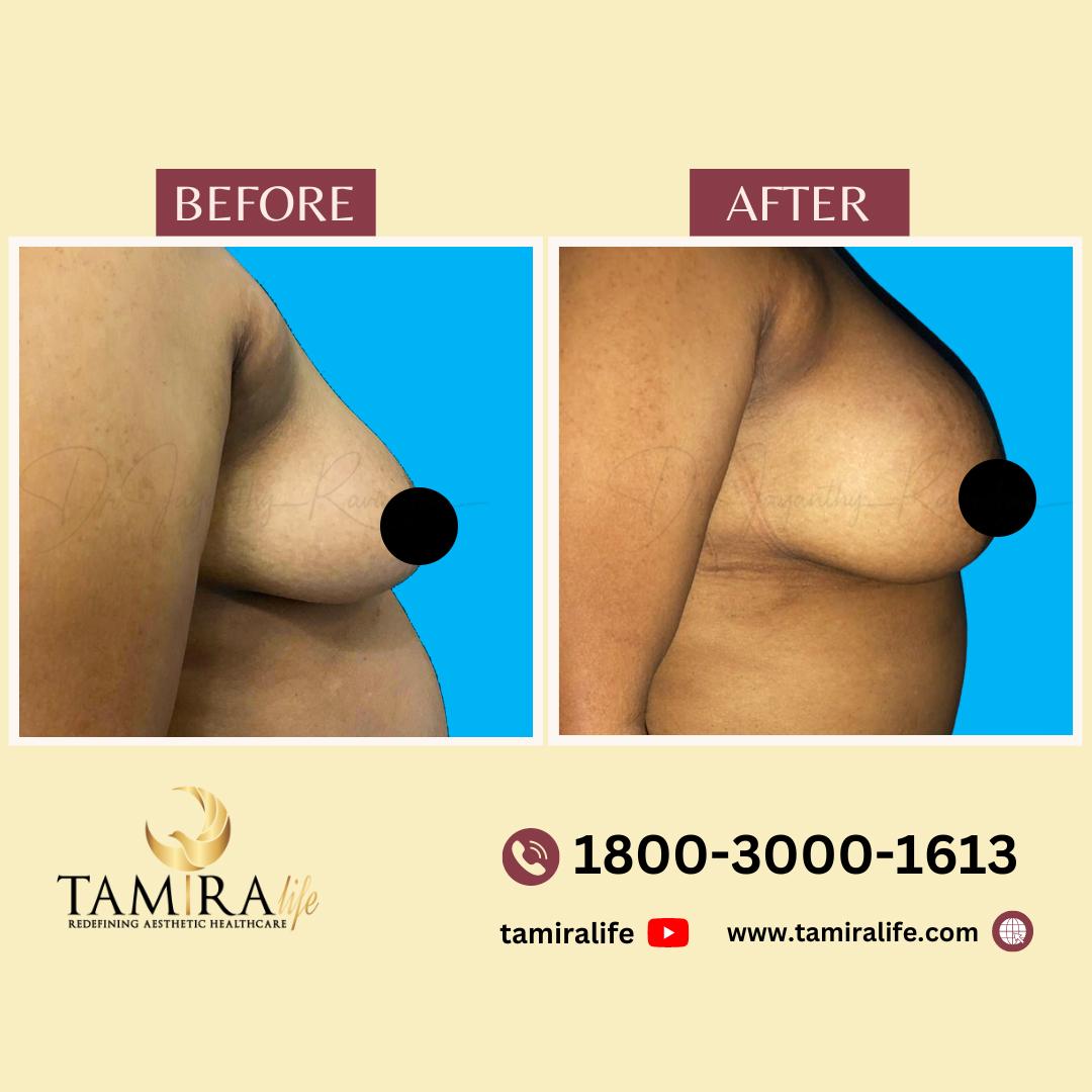 Breast Implant