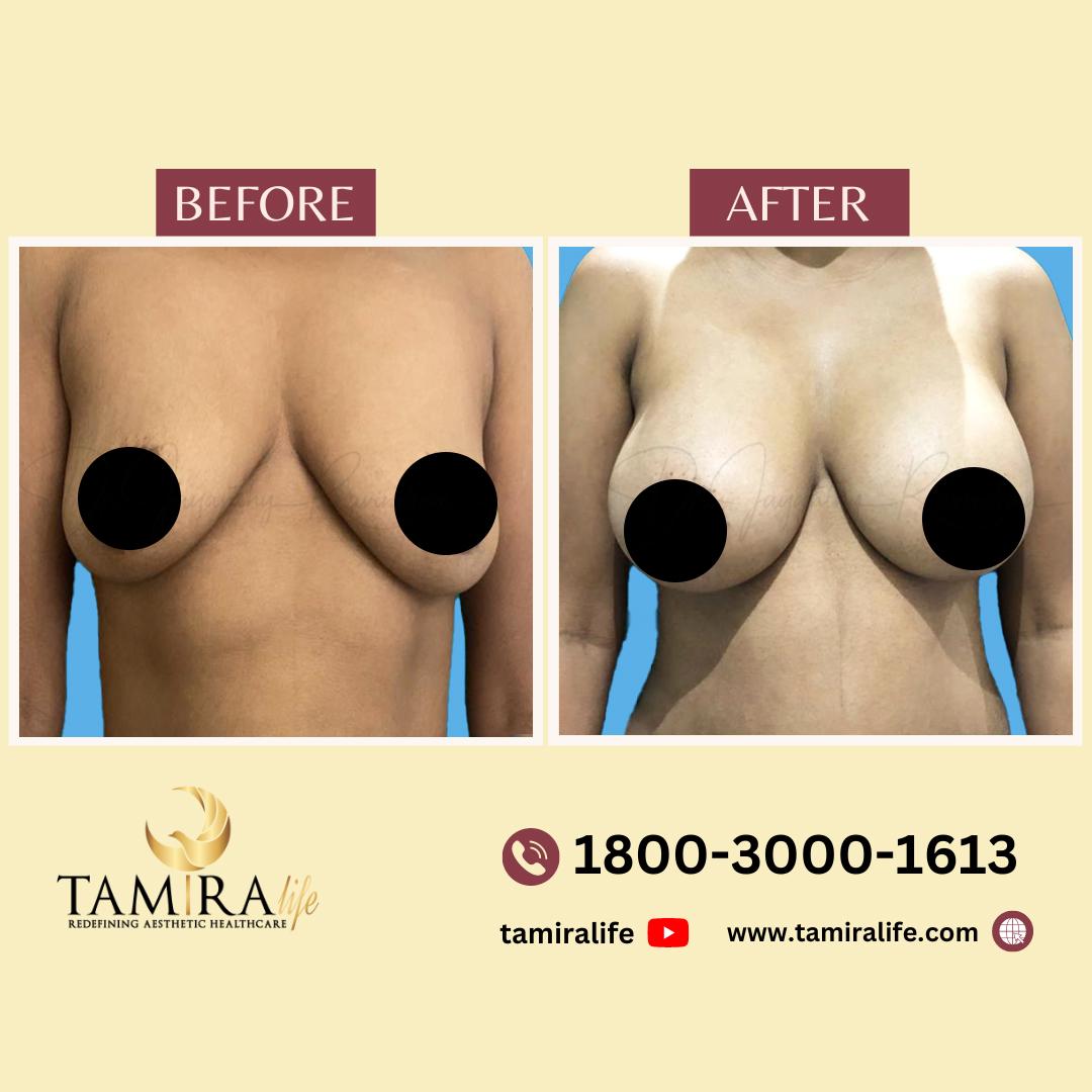 Breast Implant