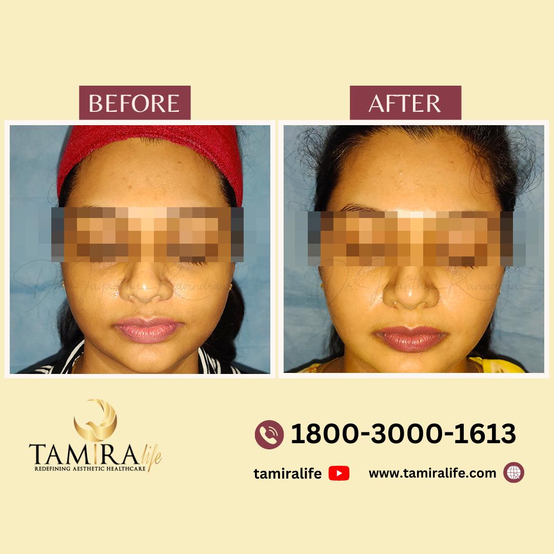 Chemical Peel
