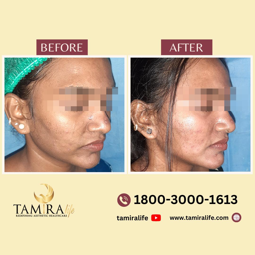 Dermamelan Peel