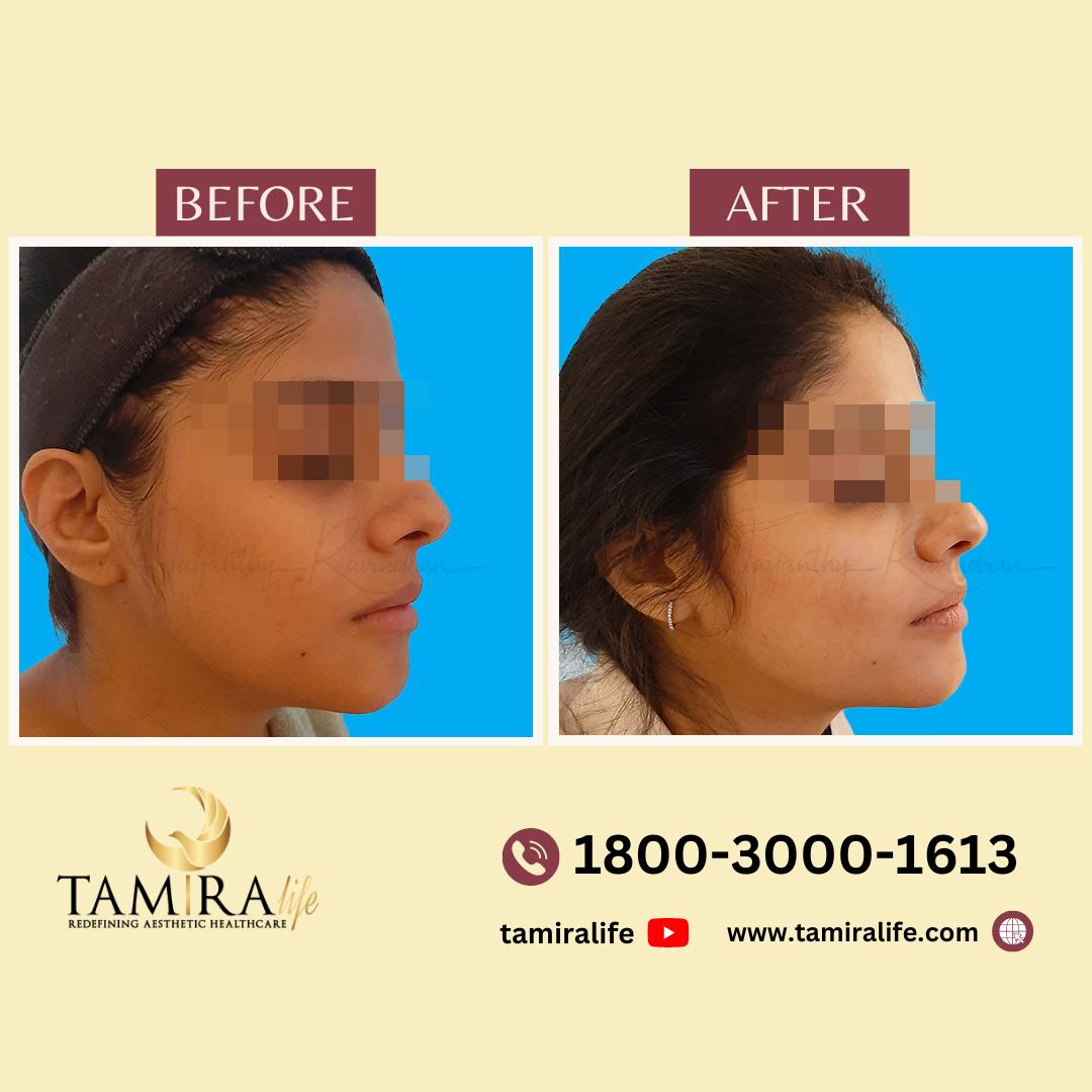 Dermamelan Peel