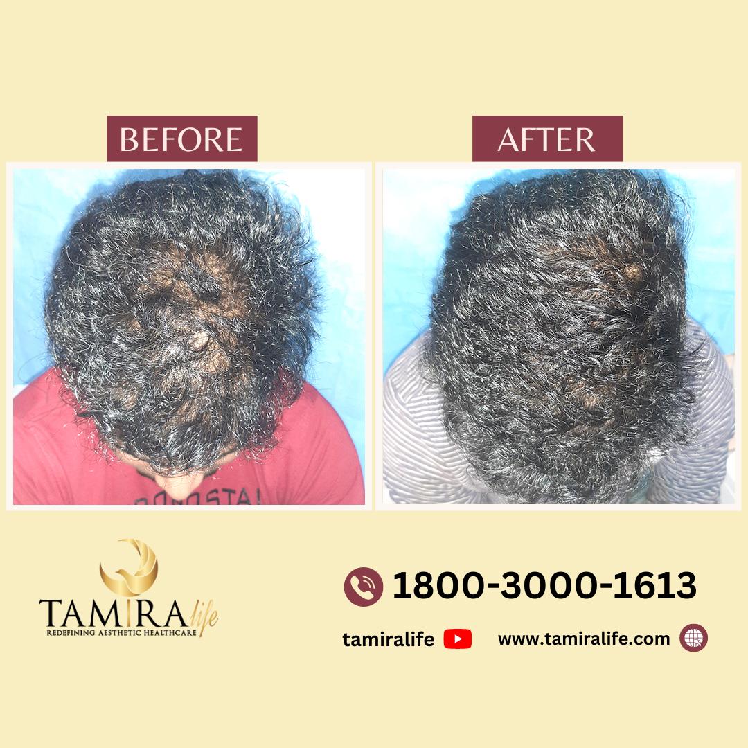 scalp micropigmentation