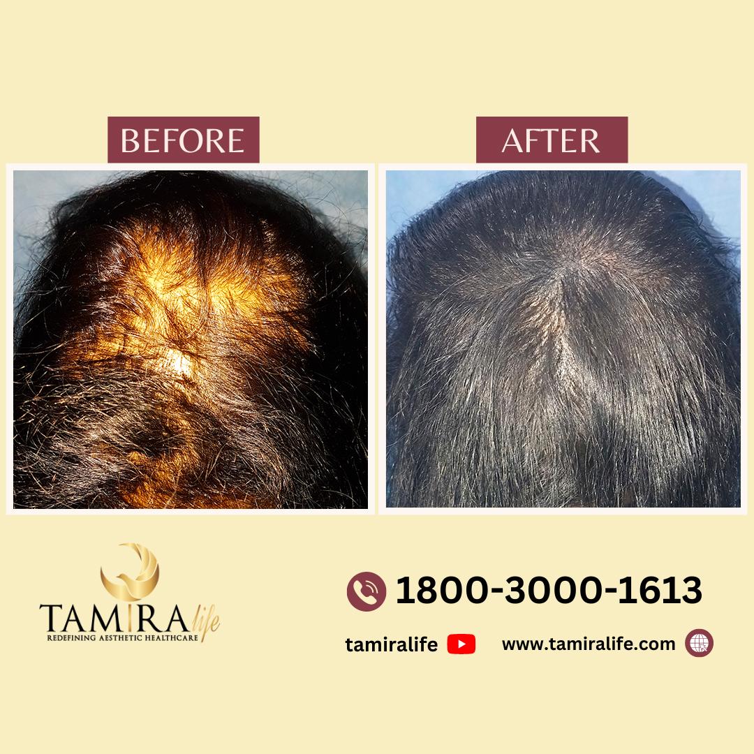 Scalp Micropigmentation