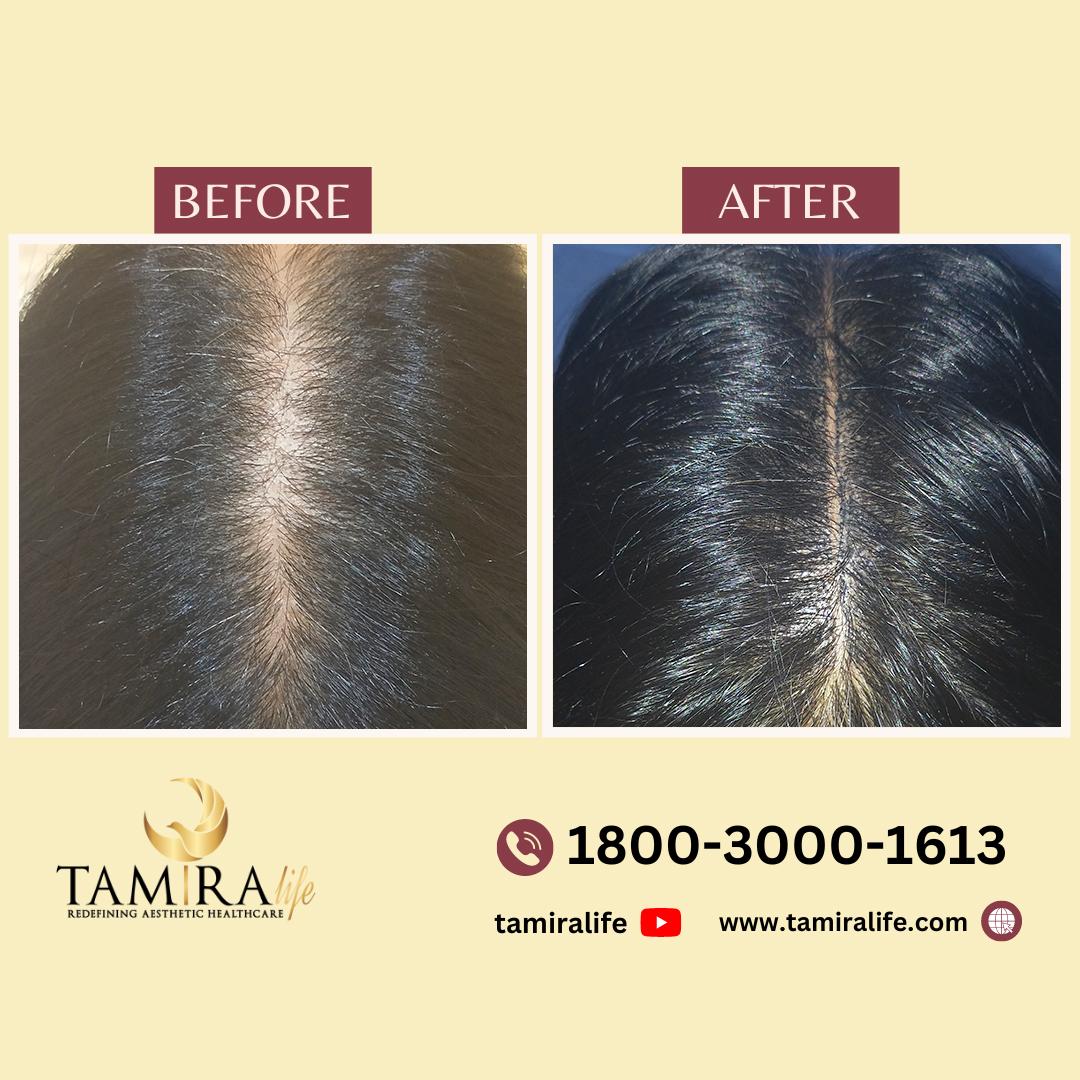Scalp Micropigmentation