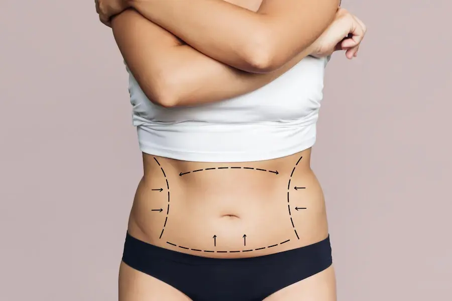 Frequently Asked Lipo Questions