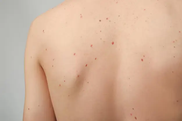 What Do You Need to Know About Birthmarks in Newborn Babies