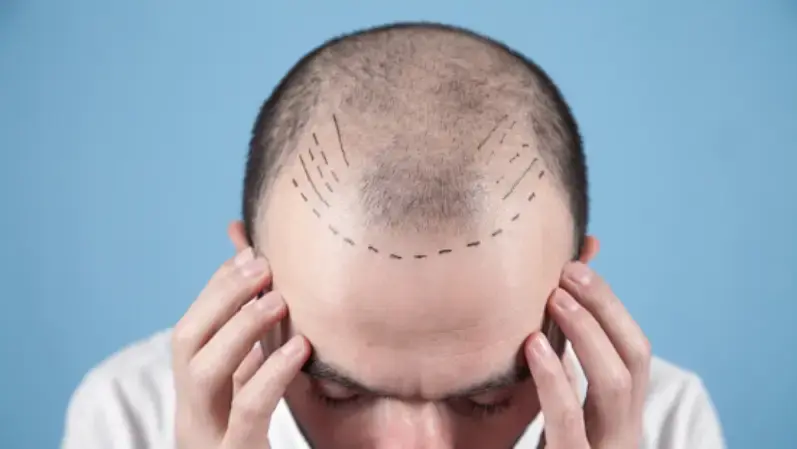Image of a man with baldness