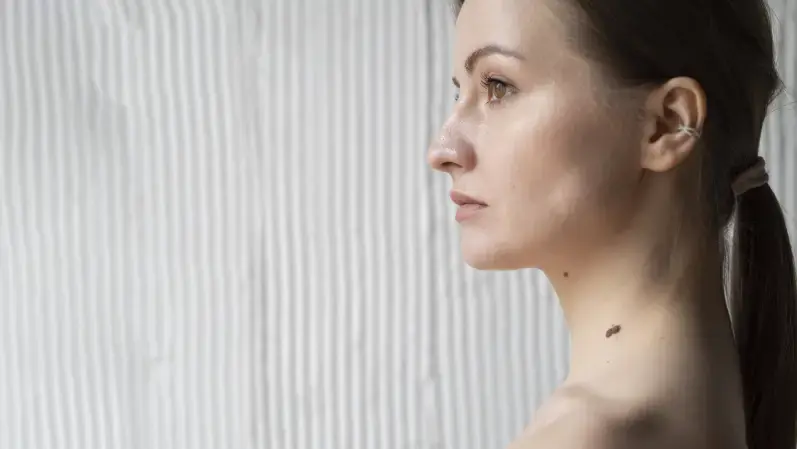 skin tags on woman's neck