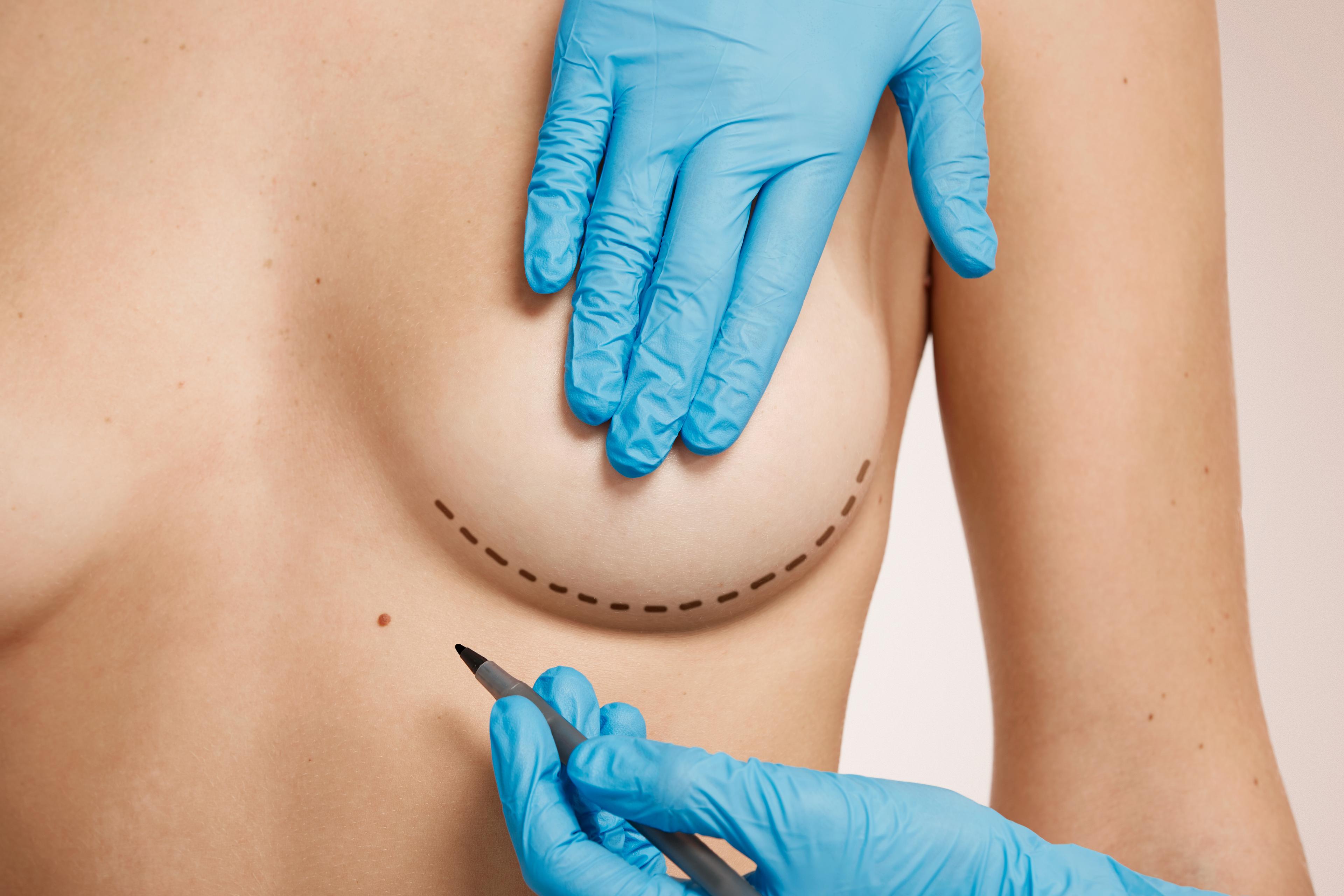 breast liposuction