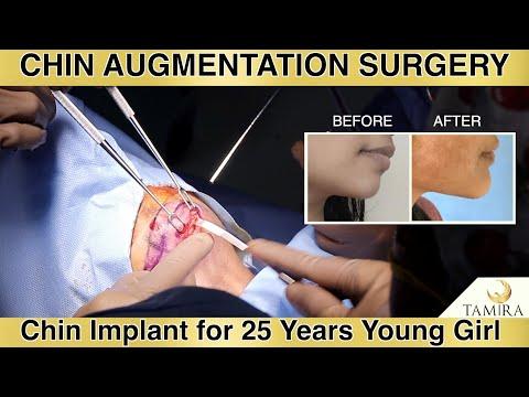 Chin Augmentation - Before & After
